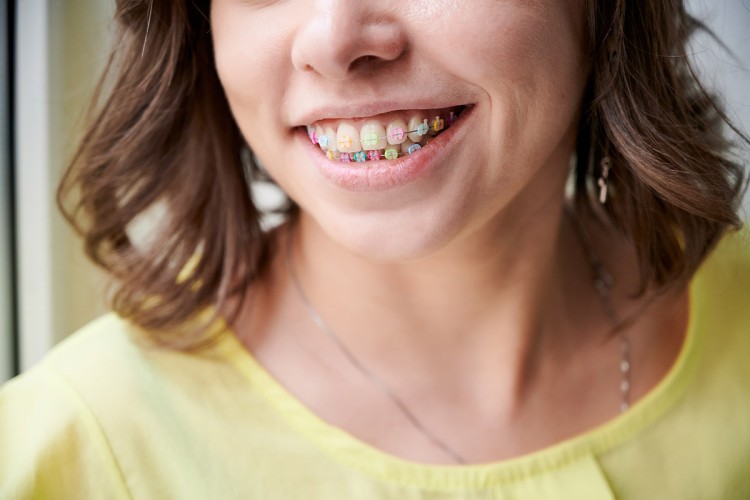 Orthodontie voor kinderen, om afwijkende tandposities te corrigeren